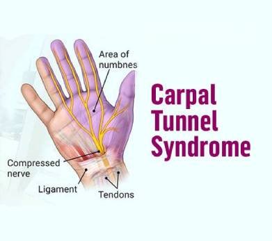 carpal-tunnel